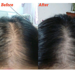 20ml Hair Growth Serum Derma Scalp Triple Roll Massager Fast Regrow Hairline Hair Loss Essence S1