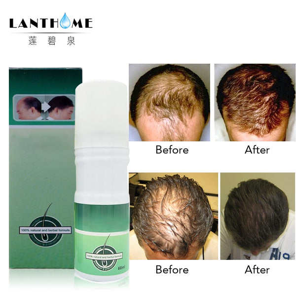 Hot powerful pilatory hair growth Hair treatment original New Regain Hair Loss Treatment Extra Stong Fast Growth 60 ml
