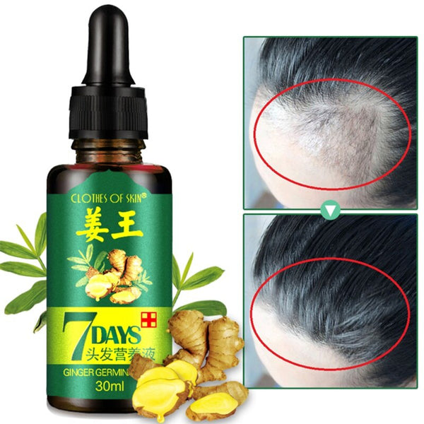 Hair Loss Treatment 7 Days Ginger Hair Growth Serum For Thicker Healthier Hair Hair Care For Men And Women